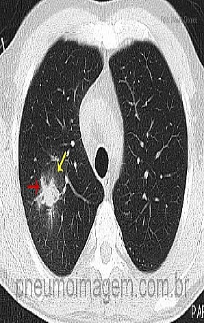 NOVO ESTUDO QUESTIONA O PAPEL DA GALACTOMANANA NO LAVADO PARA O DIAGN�STICO DE DOEN�A F�NGICA INVASIVA